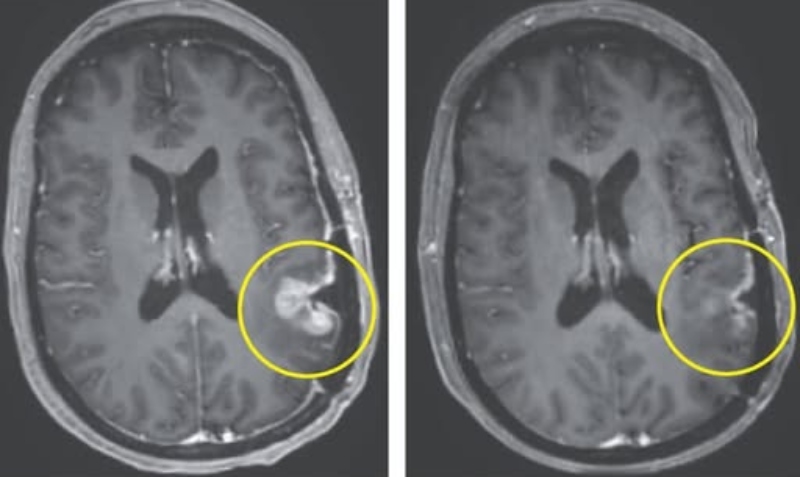 এবার এক ডোজ ক্যানসার ওষুধেই পাঁচ দিনে প্রায় গায়েব হলো মস্তিষ্কের টিউমার!